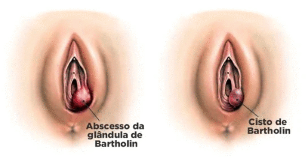Imagem didática e ilustrativa glândula Bartholin