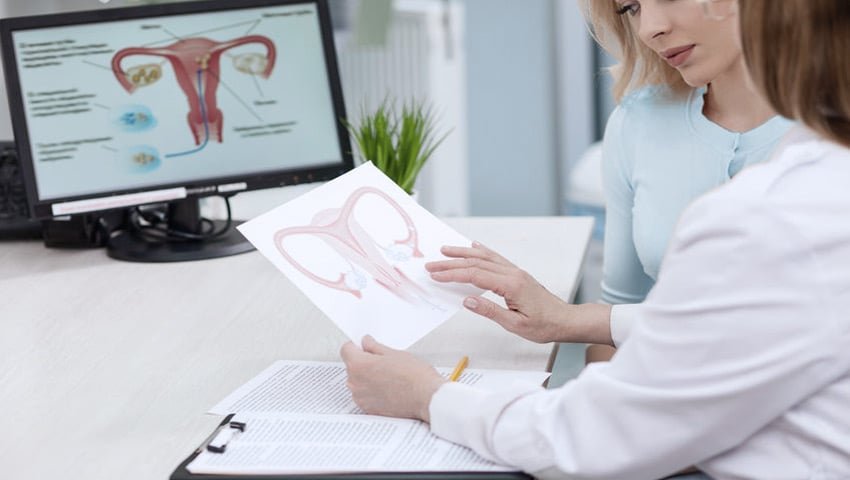 Ilustração detalhada da adenomiose uterina mostrando a localização do tecido endometrial dentro do miométrio