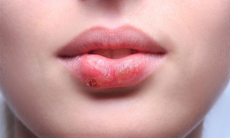 Feridas características do herpes labial nos lábios