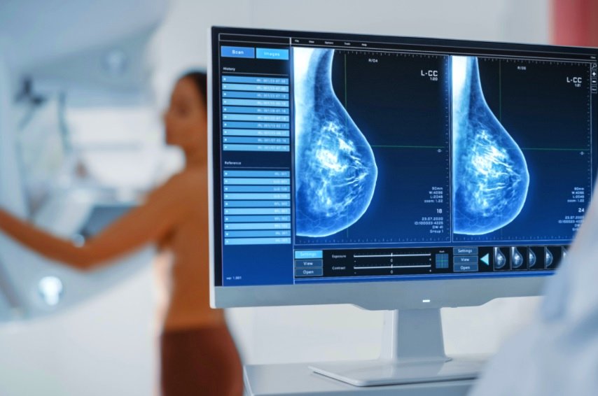Mulheres realizando mamografias, simbolizando a importância do diagnóstico precoce do câncer de mama no Brasil