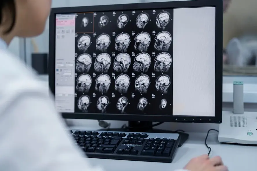Representação da atividade cerebral em indivíduos com esquizofrenia e bipolaridade
